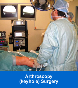 Arthroscopy Surgery